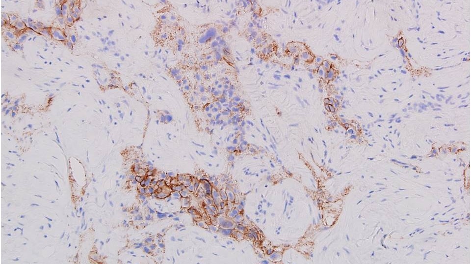 etastatic_tumor_cells_are_moderately_positive_for_HER2_2._IHC_stain_20X_magnification._Jian-Hua_Qiao_MD_FCAP_Los_Angeles_CA_USA_1-203385-edited.jpg